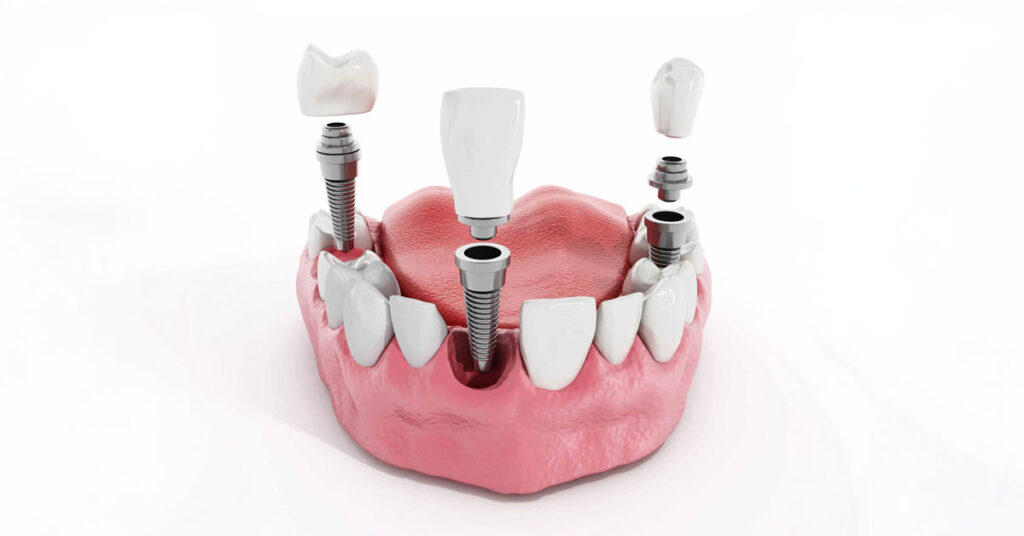 The Step-by-Step Process of Getting Dental Implants in Abu Dhabi
