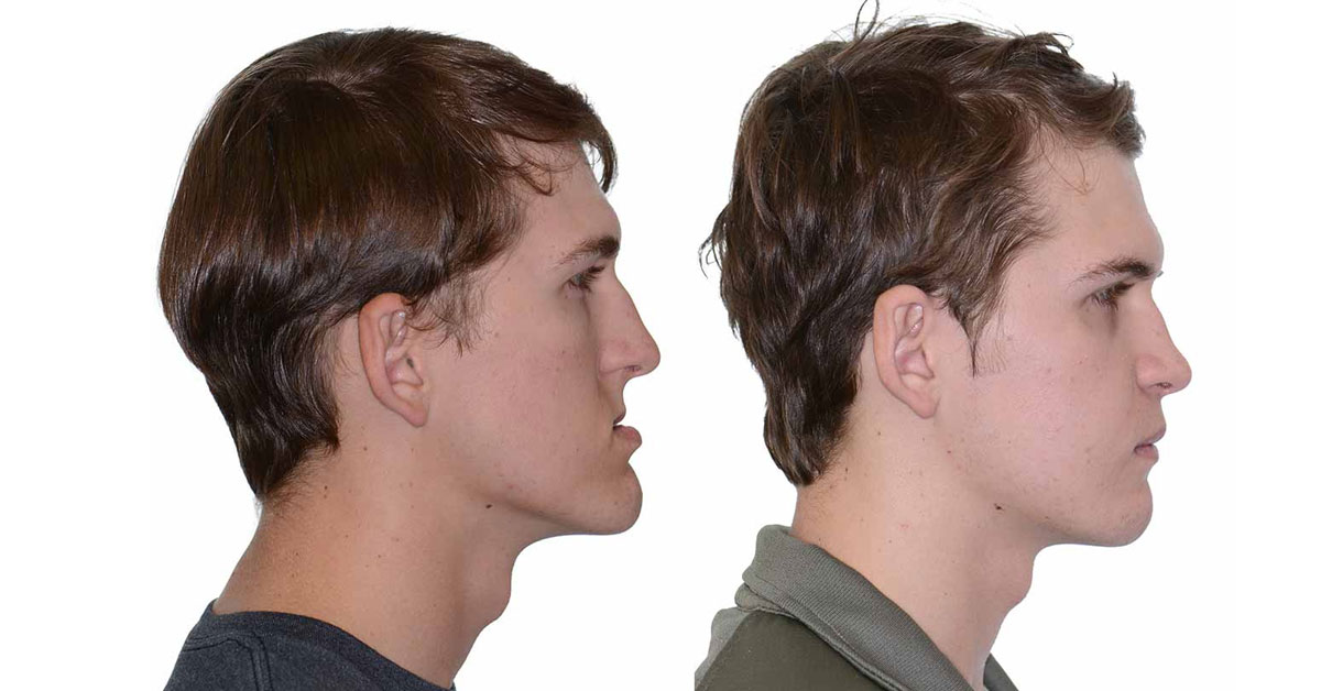 Corrective Jaw Surgery in Abu Dhabi: Life-Changing Results from Al Bustan Plus