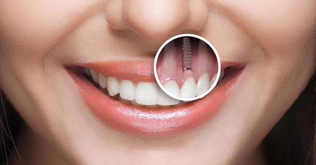 Am I a Candidate for Dental Implants? Al Bustan Plus Answers Your Questions