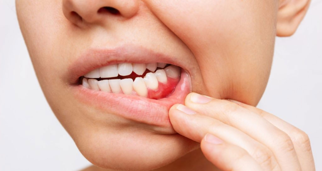 How to Prevent Gum Disease: Essential Tips for Healthy Gums