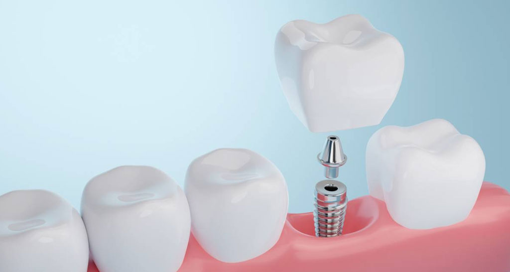 Why Choose Dental Implants? Benefits, Process, and Long-Term Care