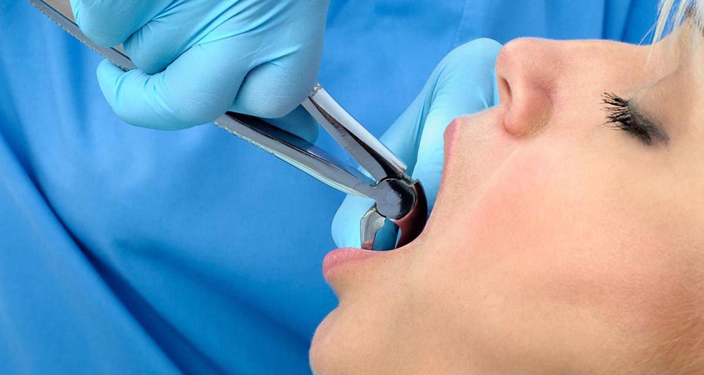 When Is Tooth Extraction Necessary? Everything You Need to Know