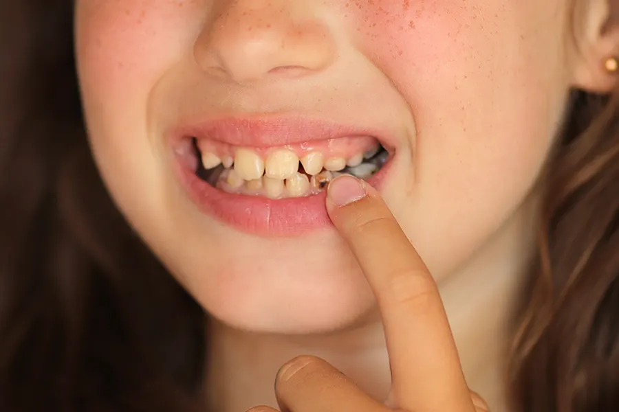 Most Common Cause of Dental Caries in Children