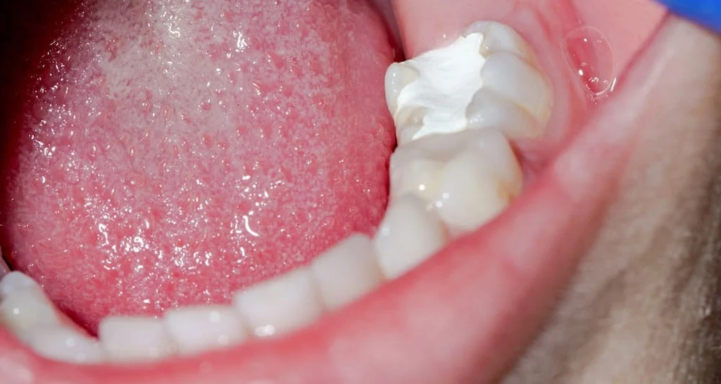 Tooth Filling in Abu Dhabi Tooth Filling in Abu Dhabi