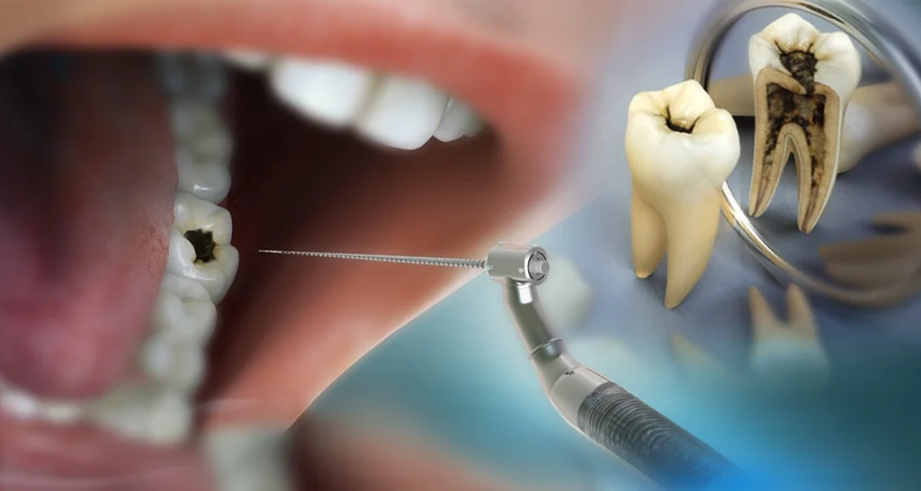 10 Warning Signs You May Need a Root Canal Treatment in Abu Dhabi