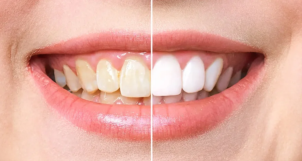 Professional vs. At-Home Teeth Whitening- What’s the Safest & Most Effective Option
