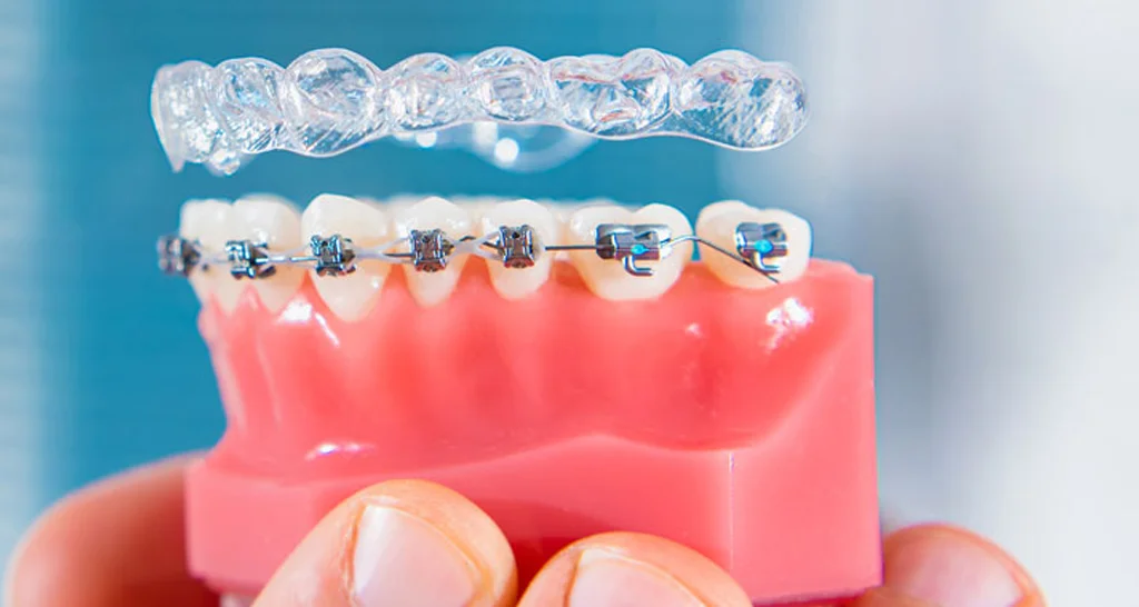 The Best Teeth Straightening Options in Abu Dhabi- Braces, Invisalign, and More