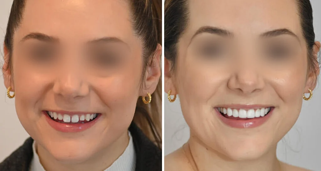 What Is a Smile Makeover How Al Bustan Plus Can Transform Your Smile